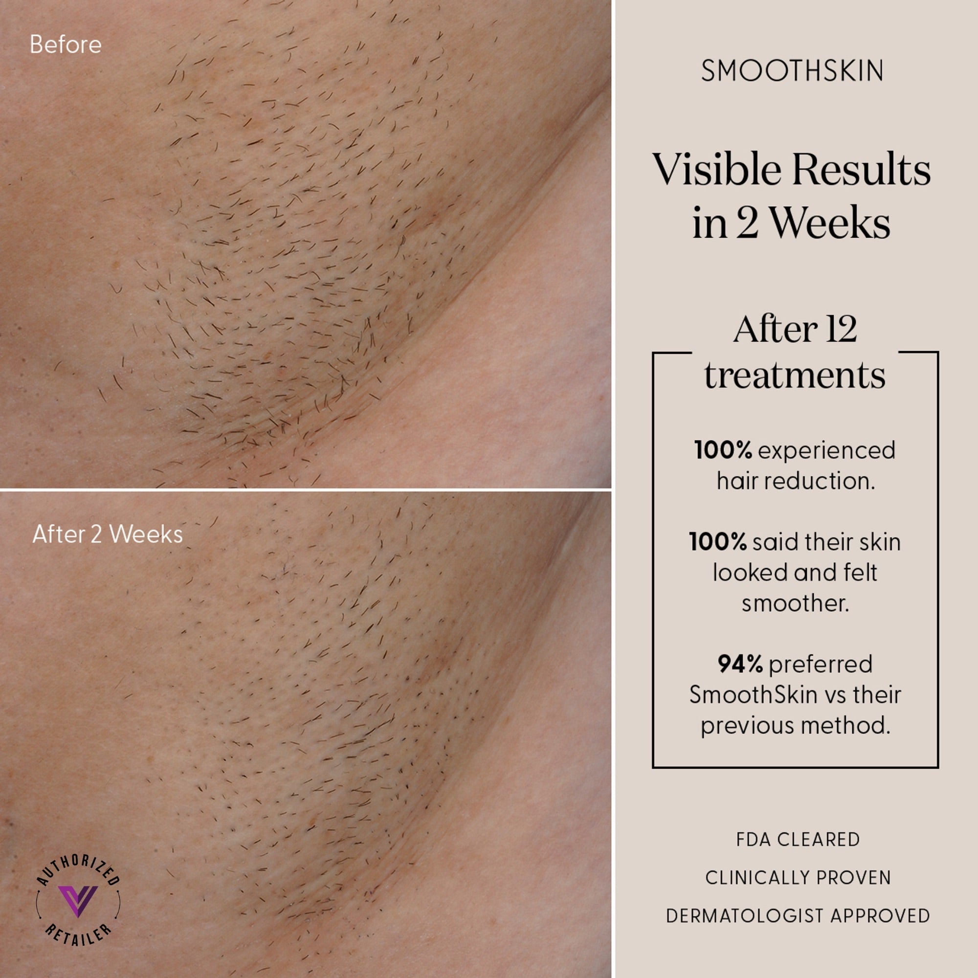 SmoothSkin Pure Adapt - Powerful IPL Hair Removal Device