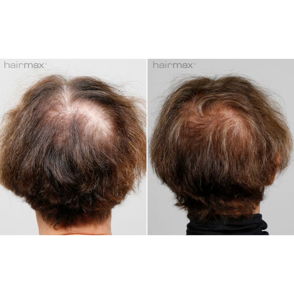 Hairmax LaserBand 41 Comfortflex (FDA Cleared)