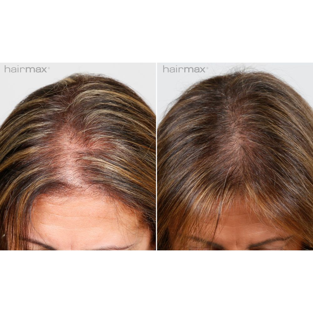 Hairmax LaserBand 41 Comfortflex (FDA Cleared)